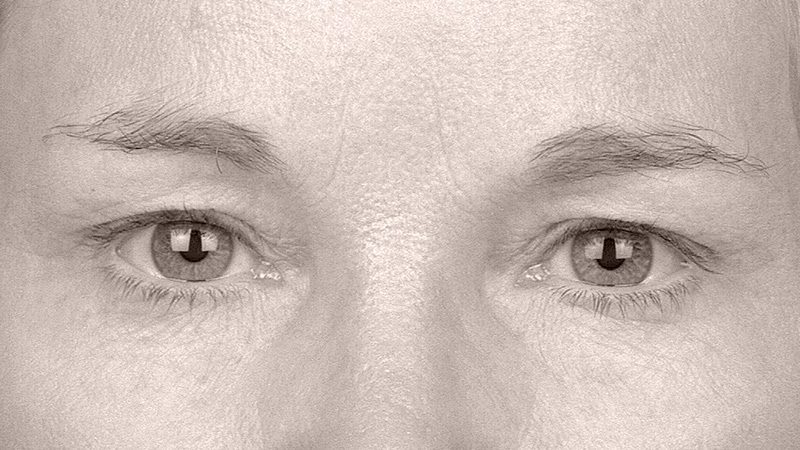 Endotine Forehead Procedure Eyes After