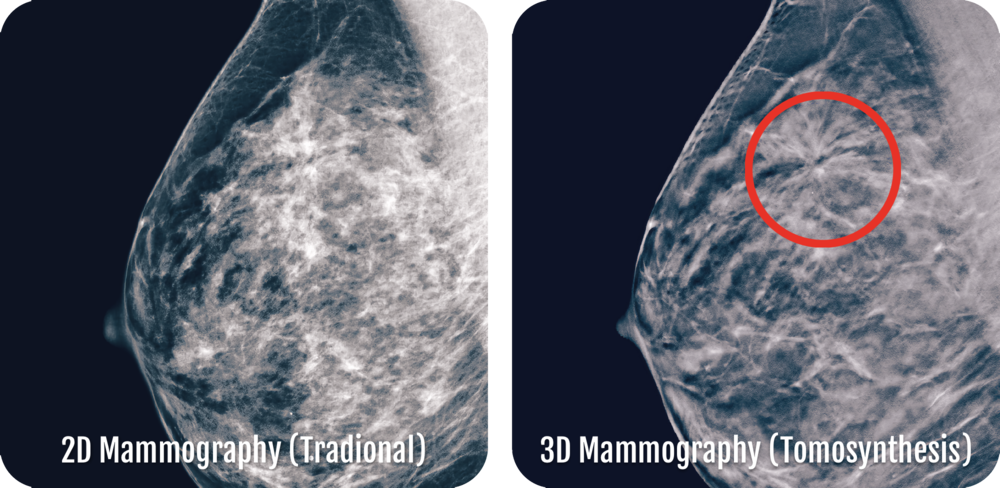 2D v 3D Mammography