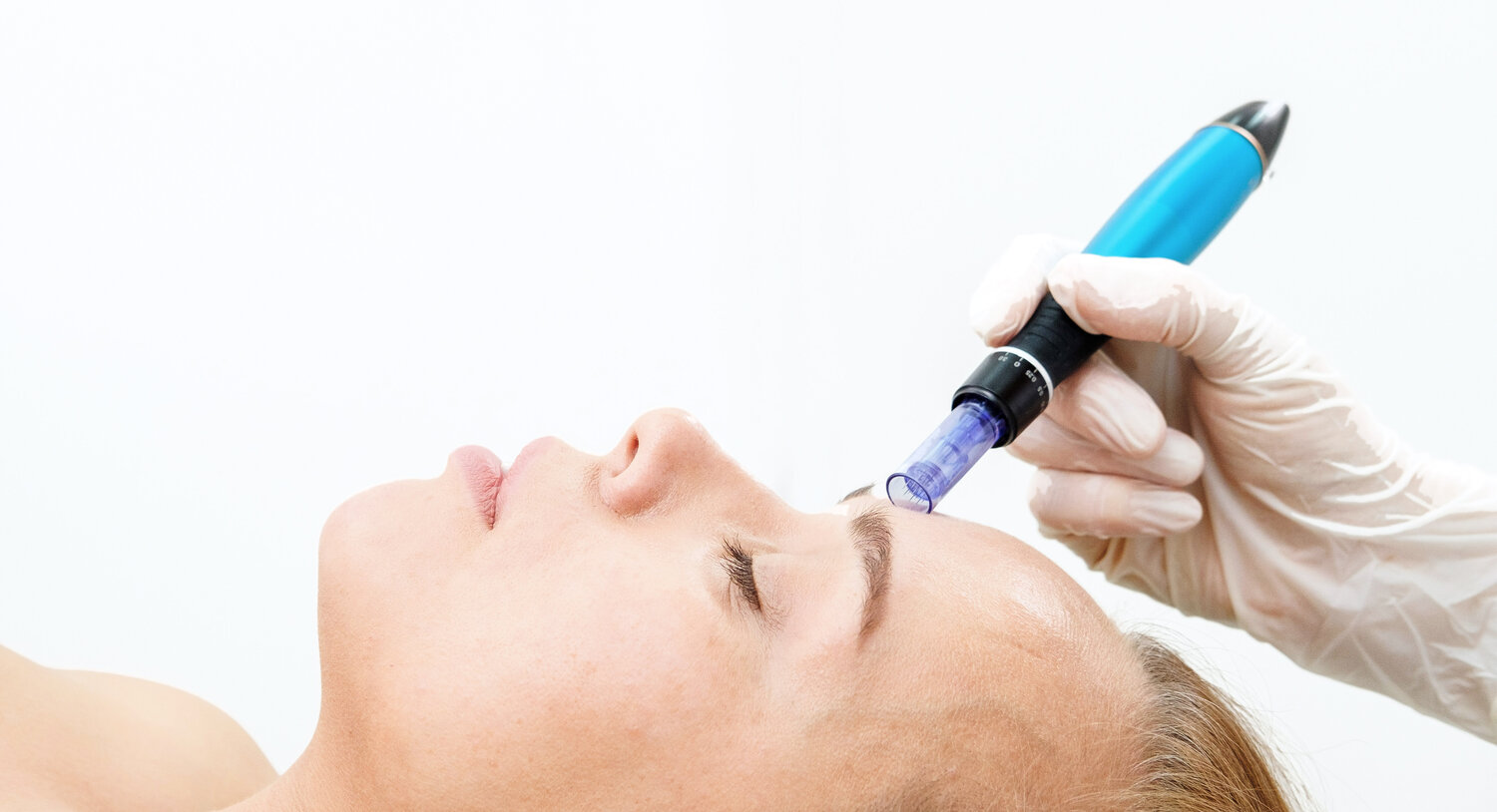 Micro-Needling: Is it worth the hype — Solace Skin Care centre