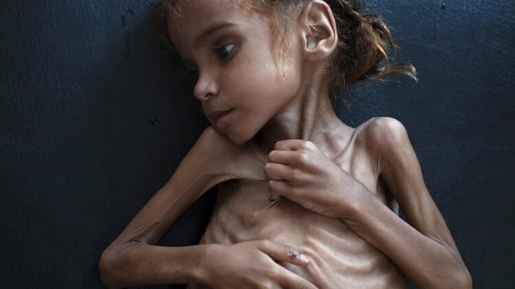 7-year old Amal Hussein, whose pictures amplified the tragedy of Yemen, succumbed to malnutrition in 2018 Credit: NYT