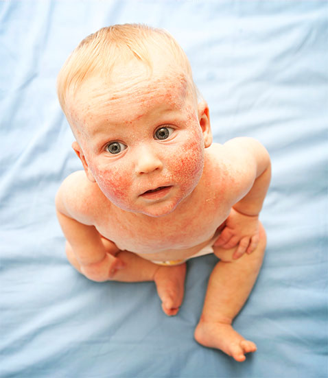 baby with eczema