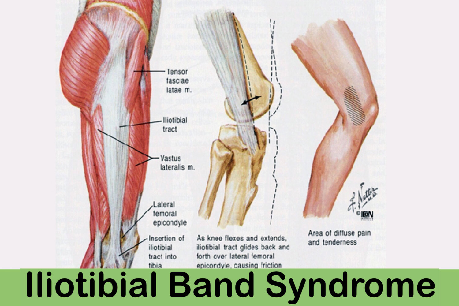 iliotibial band syndrome itbs jelentése magyarul