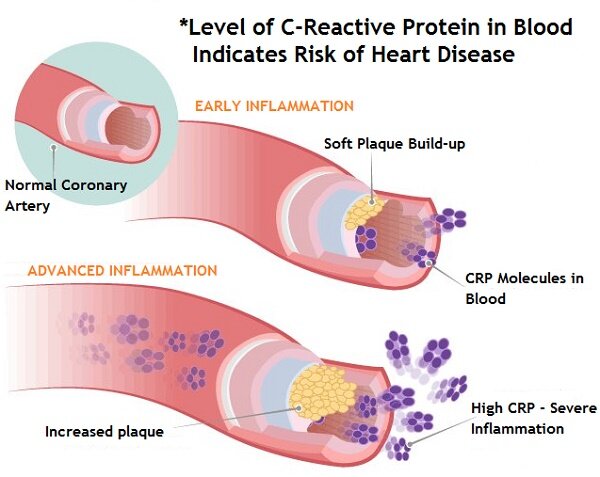 https://www.medifee.com/blog/whats-crp-c-reactive-protein-test/