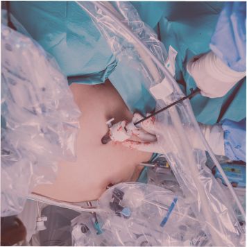 Robotic Microsurgical Tubal Surgery near me
