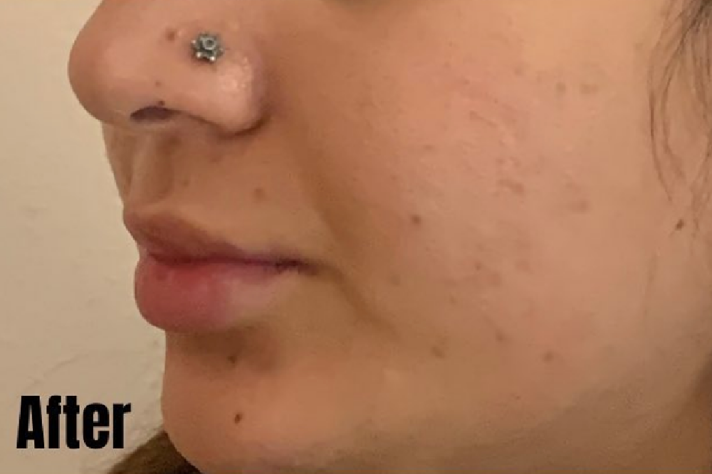 Chemical Peel in Portland Oregon After